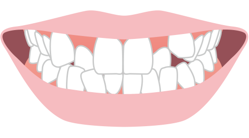 八重歯・乱杭歯(叢生)イメージ