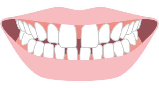 すきっ歯(空隙歯列)イメージ